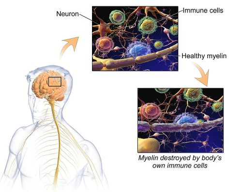this image shows where myelin is in the brain along with the difference between healthy myelin and myelin destroyed by Multiple sclerosis.